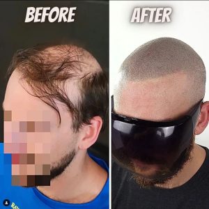 2 failed hair transplants