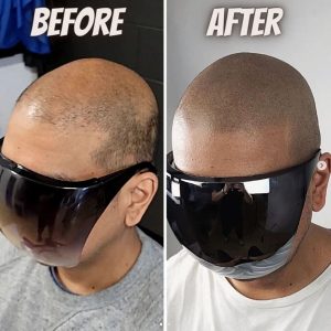 alopecia smp