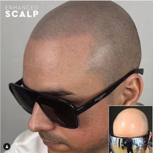 amazing scalp micro pigmentation Canada