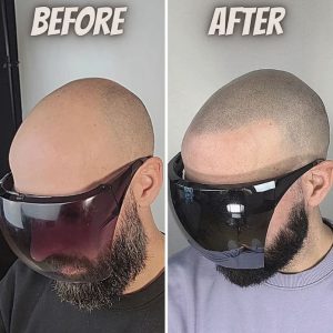 amazing scalp micropigmentation Enhanced Scalp