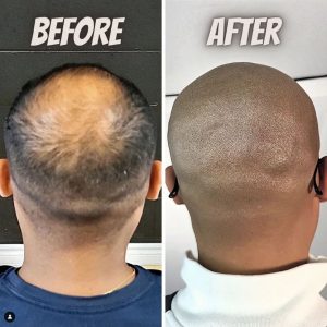 bald man fixes hair