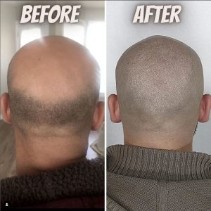 crown hair restoration