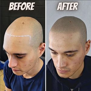 hairline fix with micropigmentation