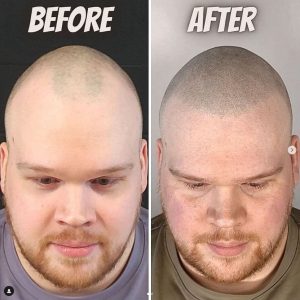 hairline restoration