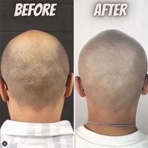 horseshoe smp before and after