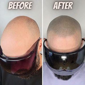 natural hairline smp
