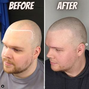 scalp micropigmentation