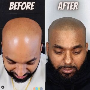smp before and after