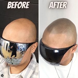 smp before and after healed