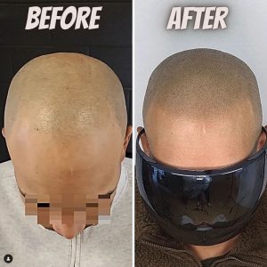 soft feathered hairline