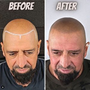 soft hairline